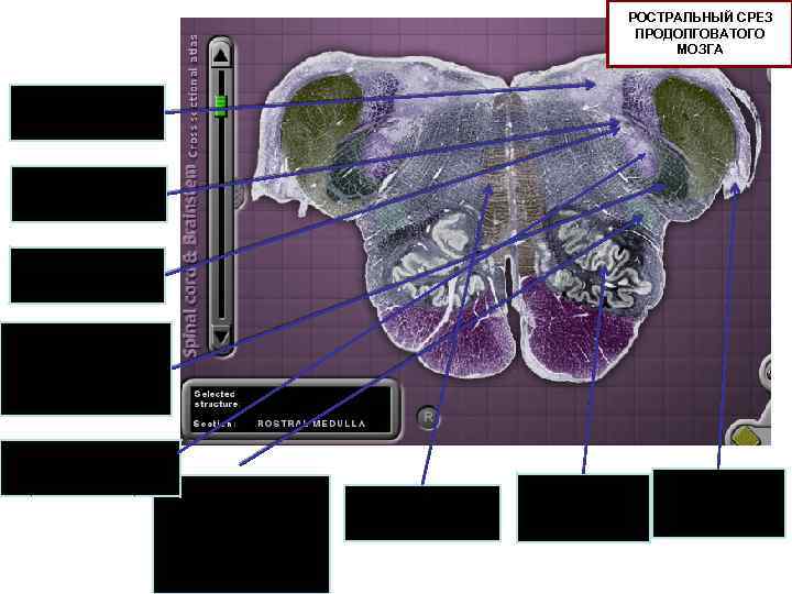 РОСТРАЛЬНЫЙ СРЕЗ ПРОДОЛГОВАТОГО МОЗГА Вестибулярные ядра Одиночный путь Одиночное ядро Спинномозговой путь тройничного нерва