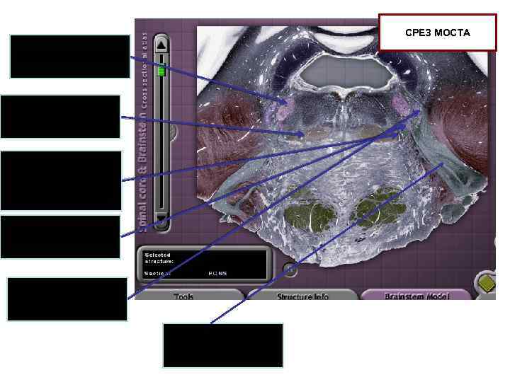 СРЕЗ МОСТА Моторное ядро тройничного нерва Медиальная петля Спинно-таламический тракт, спинномозговая петля Латеральная петля