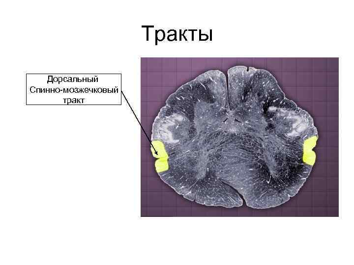 Тракты Дорсальный Спинно-мозжечковый тракт 