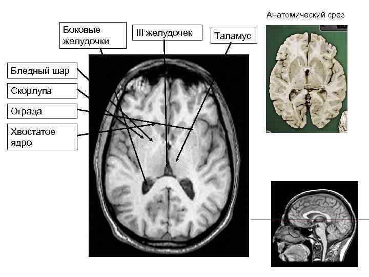 Анатомический срез Боковые желудочки Бледный шар Скорлупа Ограда Хвостатое ядро III желудочек Таламус 