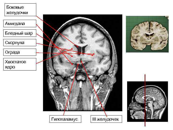 Боковые желудочки Амигдала Бледный шар Скорлупа Ограда Хвостатое ядро Гипоталамус III желудочек 