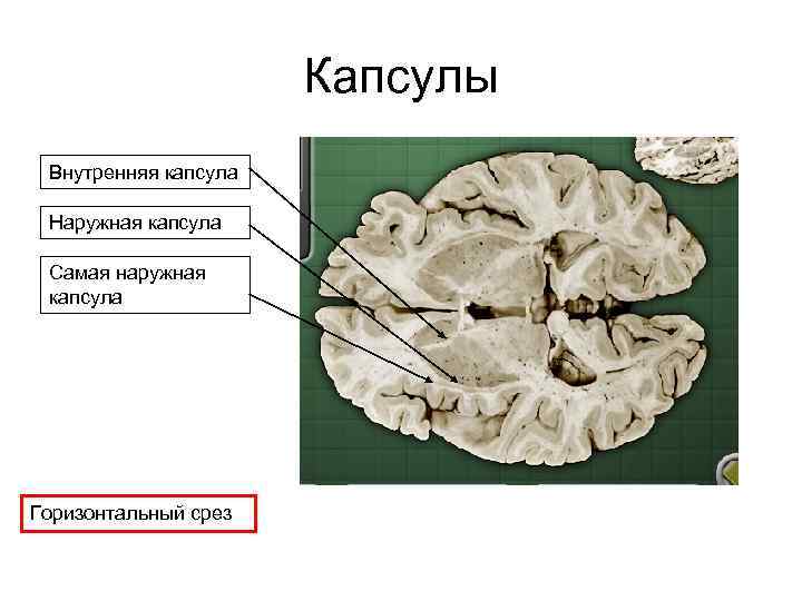 Капсулы Внутренняя капсула Наружная капсула Самая наружная капсула Горизонтальный срез 