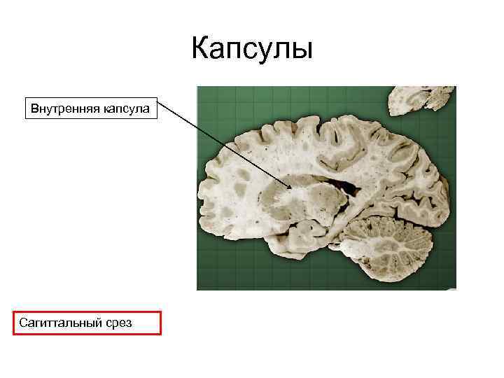 Капсулы Внутренняя капсула Сагиттальный срез 
