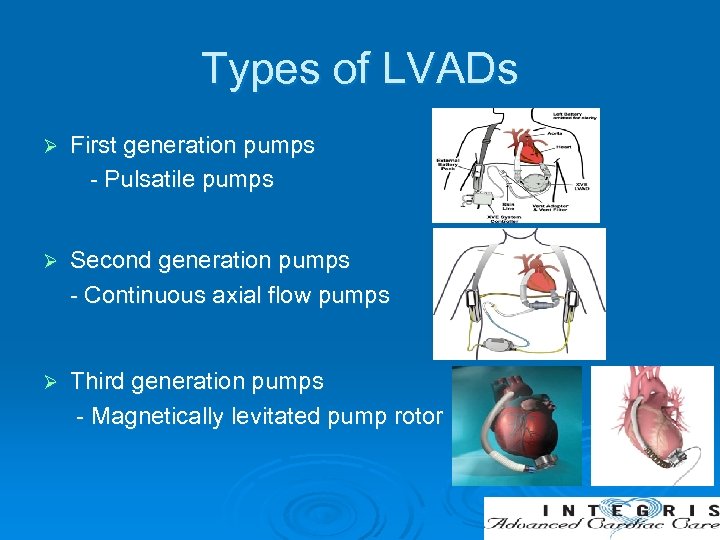 Types of LVADs Ø First generation pumps - Pulsatile pumps Ø Second generation pumps