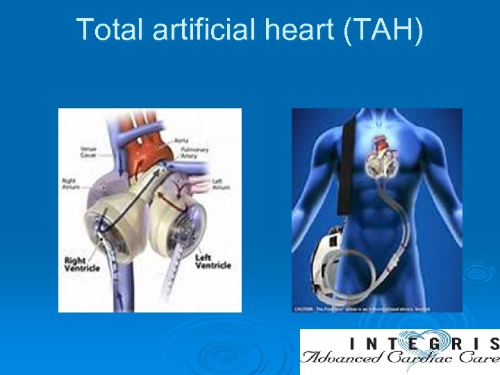 Total artificial heart (TAH) 