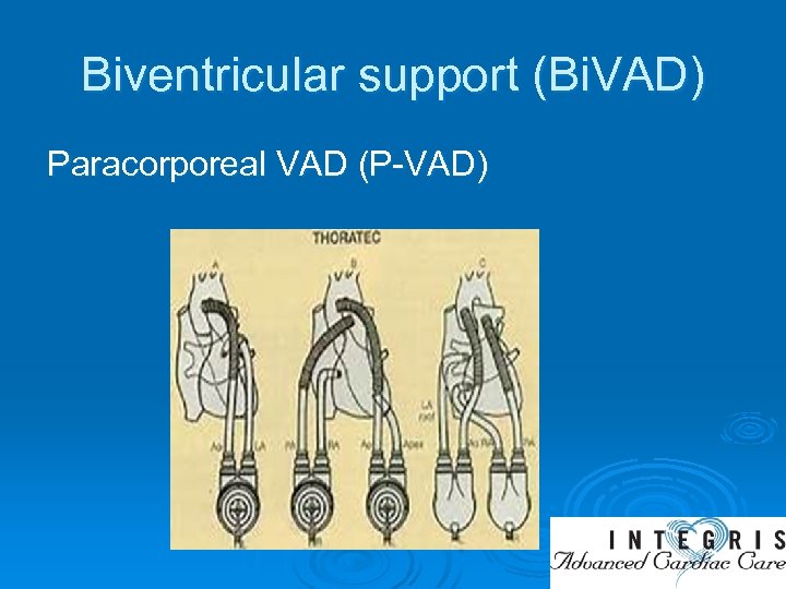 Biventricular support (Bi. VAD) Paracorporeal VAD (P-VAD) 