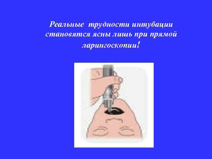 Реальные трудности интубации становятся ясны лишь при прямой ларингоскопии! 