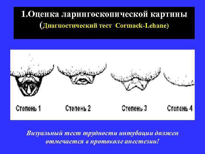 1. Оценка ларингоскопической картины (Диагностический тест Cormack-Lehane) Визуальный тест трудности интубации должен отмечается в