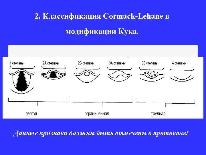 2. Классификация Cormack-Lehane в модификации Кука. Данные признаки должны быть отмечены в протоколе! 