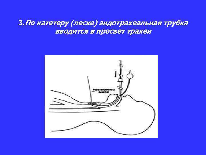 Техника постановки газоотводной трубки алгоритм