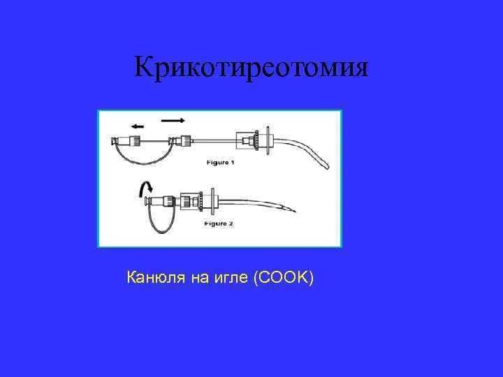 Крикотиреотомия Канюля на игле (COOK) 