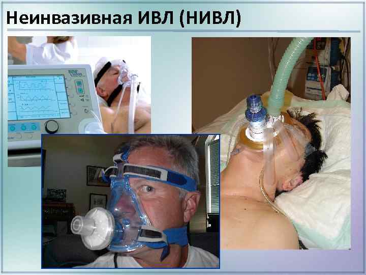 Неинвазивная ИВЛ (НИВЛ) 