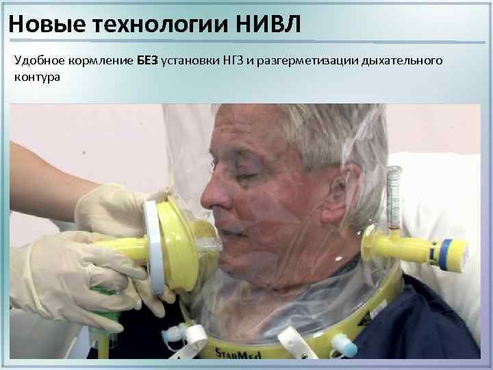 Новые технологии НИВЛ Удобное кормление БЕЗ установки НГЗ и разгерметизации дыхательного контура 