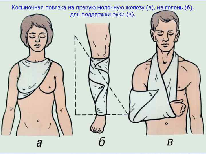Косыночная повязка на правую молочную железу (а), на голень (б), для поддержки руки (в).
