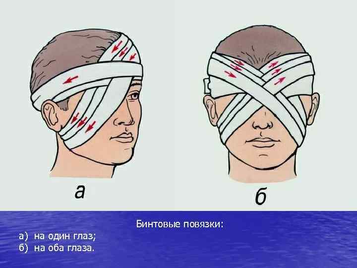 а) на один глаз; б) на оба глаза. Бинтовые повязки: 