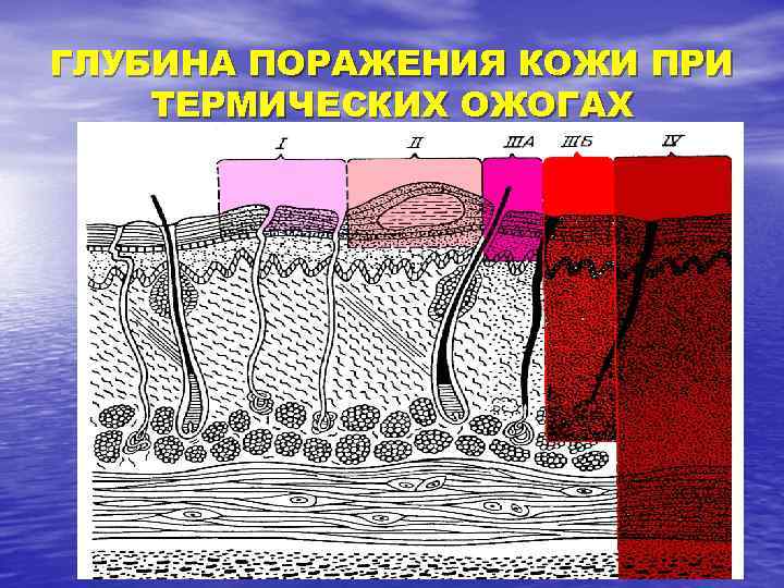 ГЛУБИНА ПОРАЖЕНИЯ КОЖИ ПРИ ТЕРМИЧЕСКИХ ОЖОГАХ 