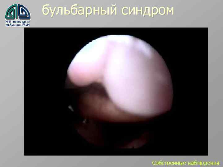 бульбарный синдром Собственные наблюдения 