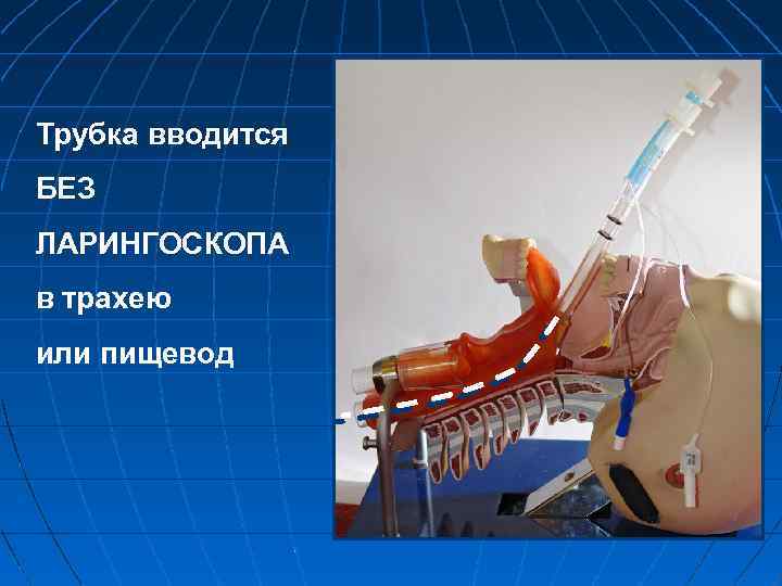 Трубка вводится БЕЗ ЛАРИНГОСКОПА в трахею или пищевод 