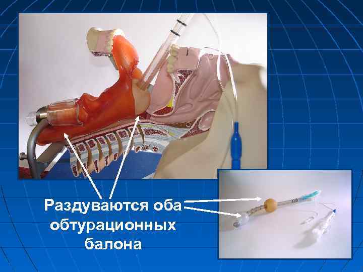 Раздуваются оба обтурационных балона 