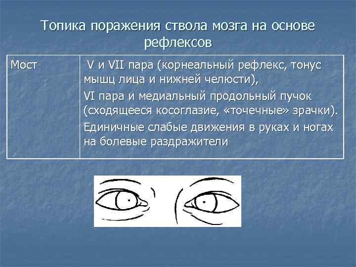 Топика поражения ствола мозга на основе рефлексов Мост V и VII пара (корнеальный рефлекс,