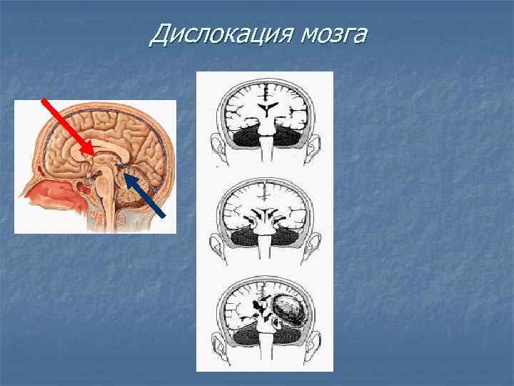 Дислокация мозгах