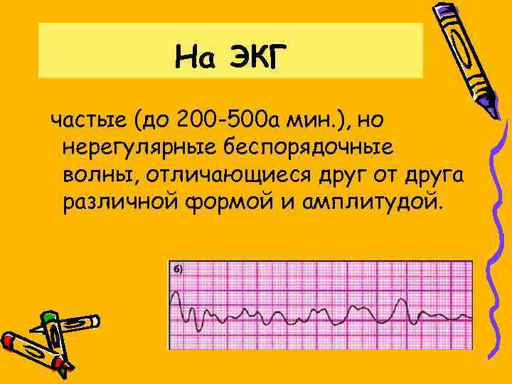 На ЭКГ частые (до 200 -500 а мин. ), но нерегулярные беспорядочные волны, отличающиеся