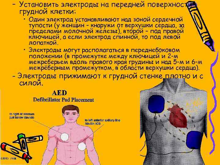 – Установить электроды на передней поверхности грудной клетки: • Один электрод устанавливают над зоной