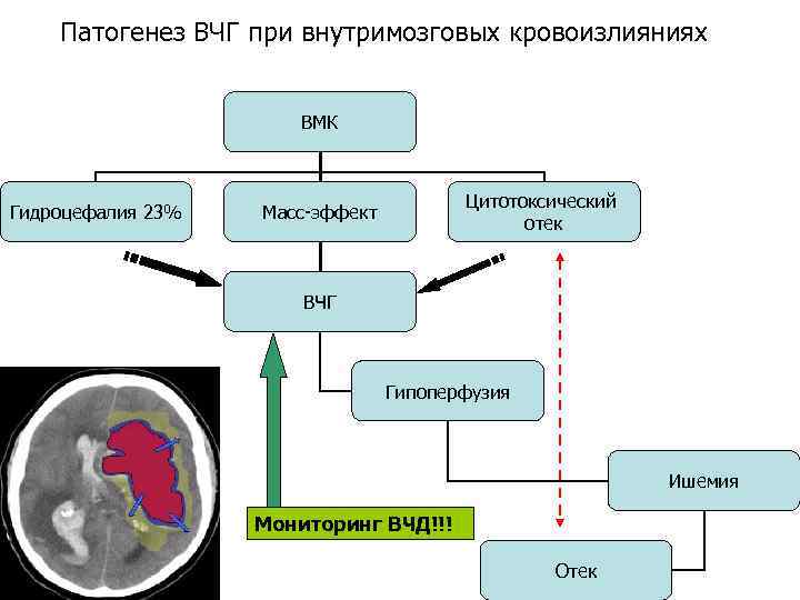 Синдром внутричерепной гипертензии патофизиологические механизмы клиническая картина