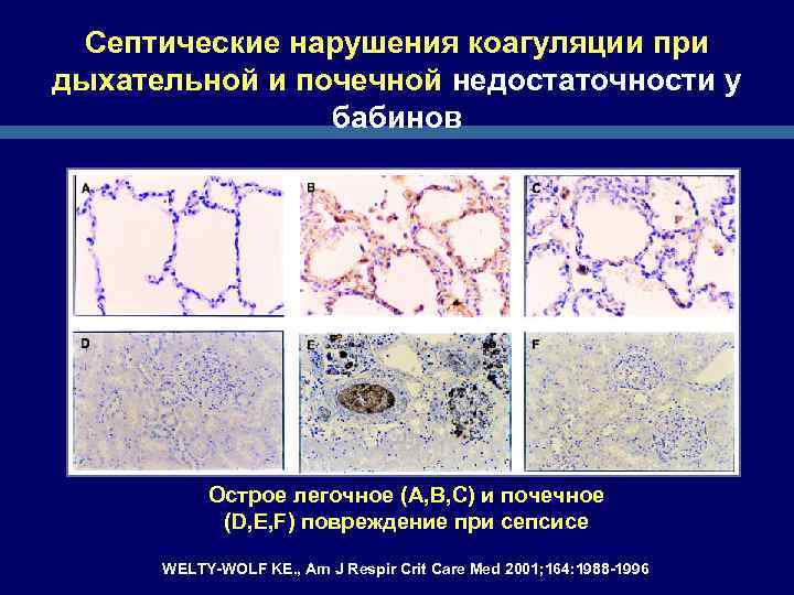 Септические нарушения коагуляции при дыхательной и почечной недостаточности у бабинов Острое легочное (A, B,