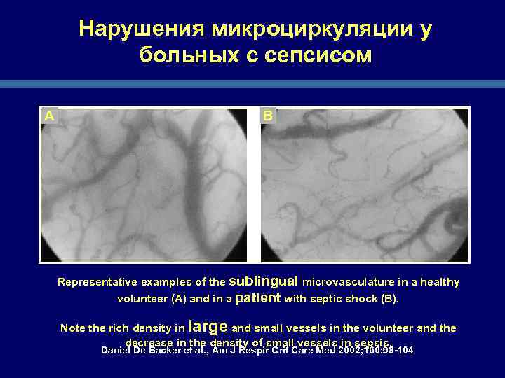 Нарушения микроциркуляции у больных с сепсисом A B Representative examples of the sublingual microvasculature