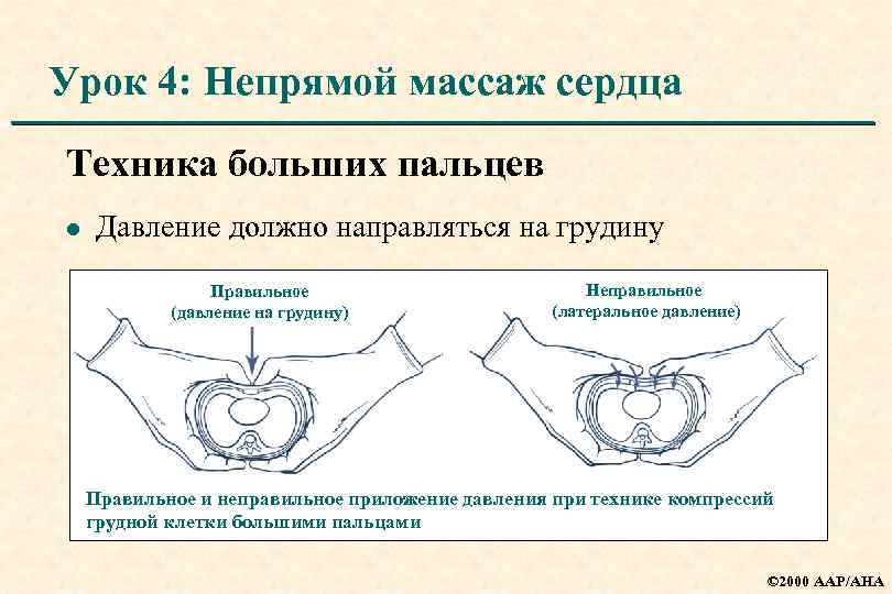 Урок 4: Непрямой массаж сердца Техника больших пальцев l Давление должно направляться на грудину