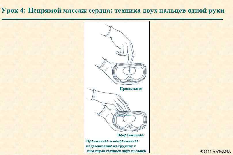 Урок 4: Непрямой массаж сердца: техника двух пальцев одной руки Правильное Неправильное Правильное и