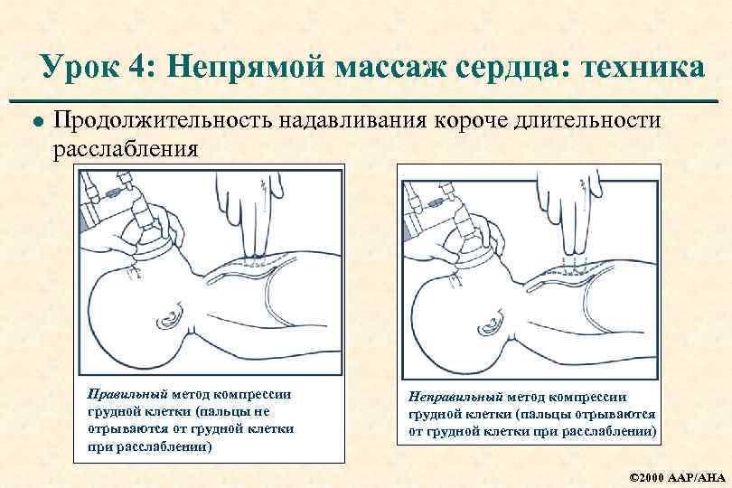 Непрямой массаж сердца. Непрямой массаж сердца глубина надавливания. Методика непрямого массажа сердца. Глубина компрессии при массаже сердца. Непрямой массаж сердца техника техника.