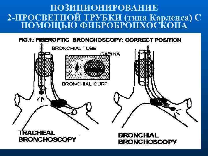 ПОЗИЦИОНИРОВАНИЕ 2 -ПРОСВЕТНОЙ ТРУБКИ (типа Карленса) С ПОМОЩЬЮ ФИБРОБРОНХОСКОПА 