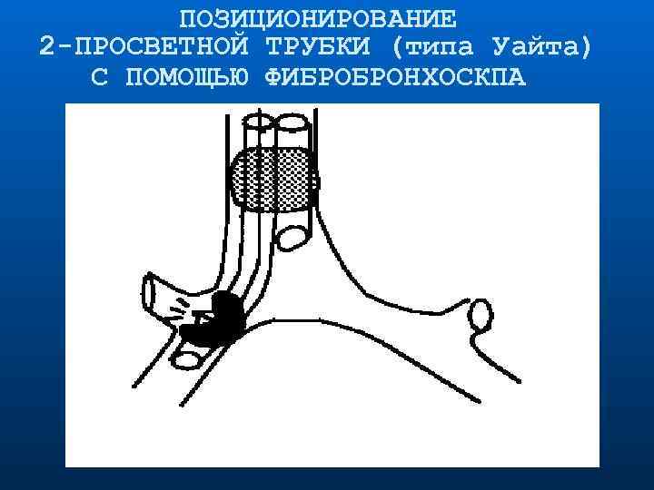 ПОЗИЦИОНИРОВАНИЕ 2 -ПРОСВЕТНОЙ ТРУБКИ (типа Уайта) С ПОМОЩЬЮ ФИБРОБРОНХОСКПА 