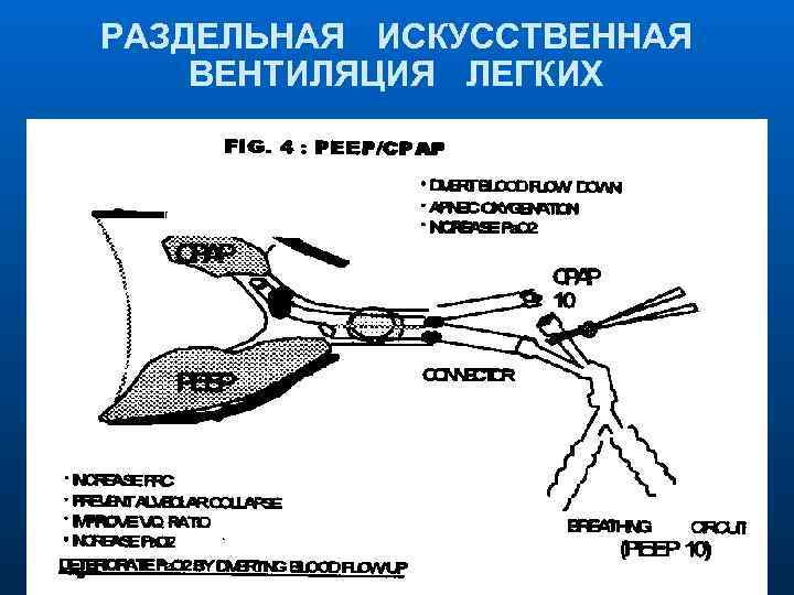 РАЗДЕЛЬНАЯ ИСКУССТВЕННАЯ ВЕНТИЛЯЦИЯ ЛЕГКИХ 