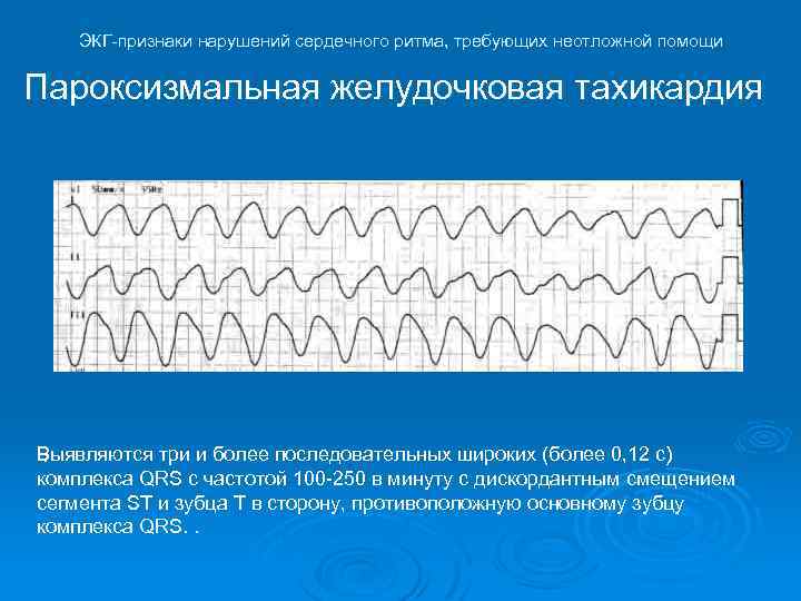 Желудочковая тахикардия экг фото