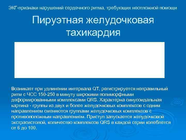 ЭКГ-признаки нарушений сердечного ритма, требующих неотложной помощи Пируэтная желудочковая тахикардия Возникает при удлинении интервала