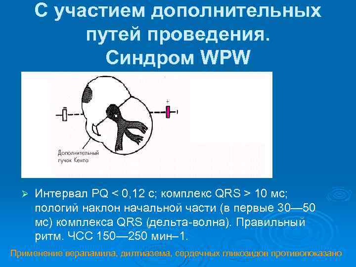 Дополнительный путь. Wpw синдром дополнительного пути проведения. Дополнительные пути проведения. Wpw дополнительные пути. При wpw пути проведения.