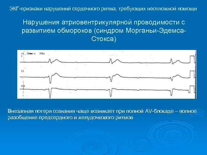 Фибрилляции предсердий карта вызова смп