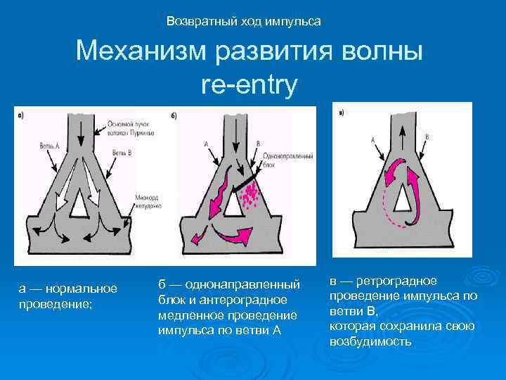 Возвратный ход импульса Механизм развития волны re-entry а — нормальное проведение; б — однонаправленный