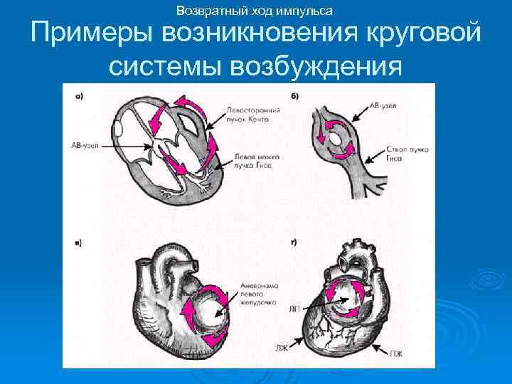 Возвратный ход импульса Примеры возникновения круговой системы возбуждения 