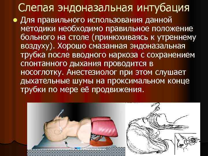 Слепая эндоназальная интубация l Для правильного использования данной методики необходимо правильное положение больного на