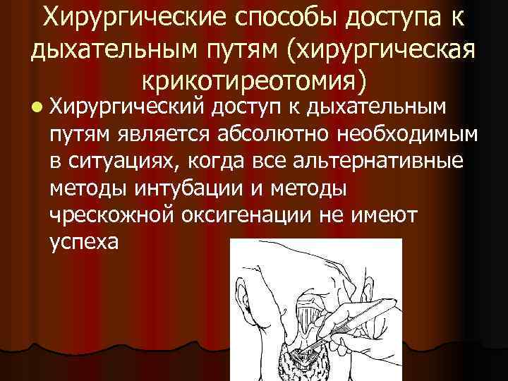 Хирургические способы доступа к дыхательным путям (хирургическая крикотиреотомия) l Хирургический доступ к дыхательным путям
