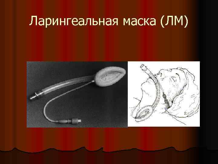 Ларингеальная маска (ЛМ) 