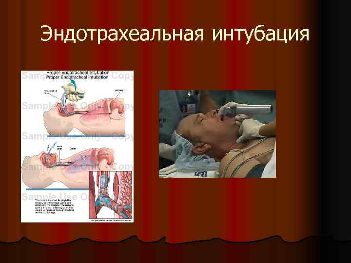 Эндотрахеальная интубация 