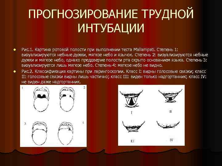 ПРОГНОЗИРОВАНИЕ ТРУДНОЙ ИНТУБАЦИИ l l Рис. 1. Картина ротовой полости при выполнении теста Mallampati.