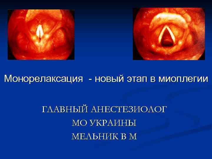 Монорелаксация - новый этап в миоплегии ГЛАВНЫЙ АНЕСТЕЗИОЛОГ МО УКРАИНЫ МЕЛЬНИК В М 