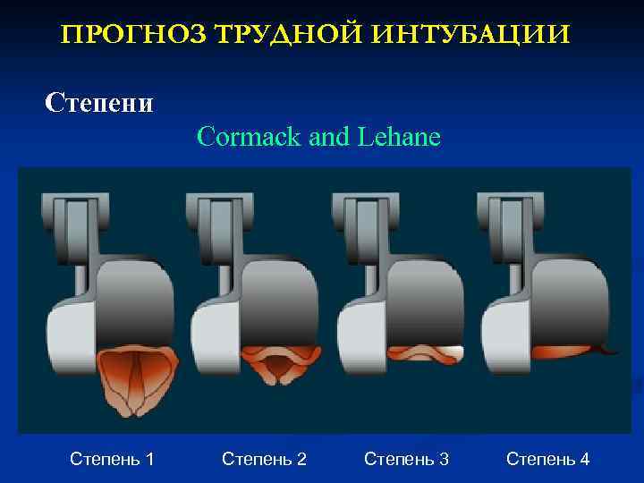 ПРОГНОЗ ТРУДНОЙ ИНТУБАЦИИ Степени Cormack and Lehane Степень 1 Степень 2 Степень 3 Степень