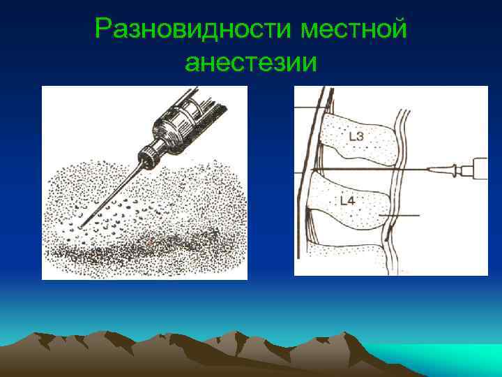 Местная анестезия схема